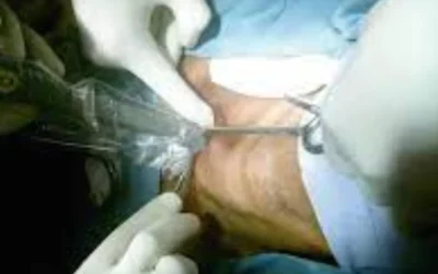 Parathyroid Surgery in India: Restoring Health with Expert Hands